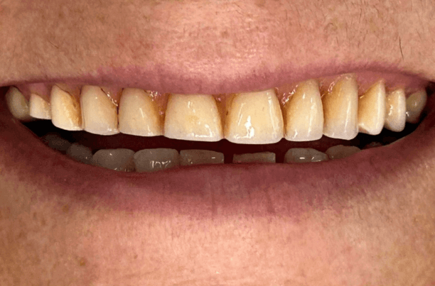 Antes do clareamento dental