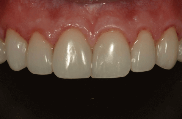 Depois das lentes de contato